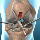 La imagen 1 de la Empresa PRÓTESIS DE CADERA Y CIRUGÍA DE RODILLA EN GUADALAJARA Salud y Medicina en Guadalajara JAL