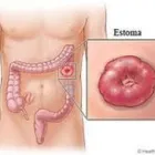La imagen 3 de la Empresa STOMA HOMECARE / MANEJO PROFESIONAL DE COLOSTOMÍAS Salud y Medicina en Monterrey NLE