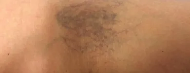 La imagen 11 de la Empresa DR. MISHELL SANTANDER BECERRA, ANGIÓLOGO Salud y Medicina en San Andrés Cholula PUE