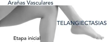 La imagen 17 de la Empresa DR. MISHELL SANTANDER BECERRA, ANGIÓLOGO Salud y Medicina en San Andrés Cholula PUE